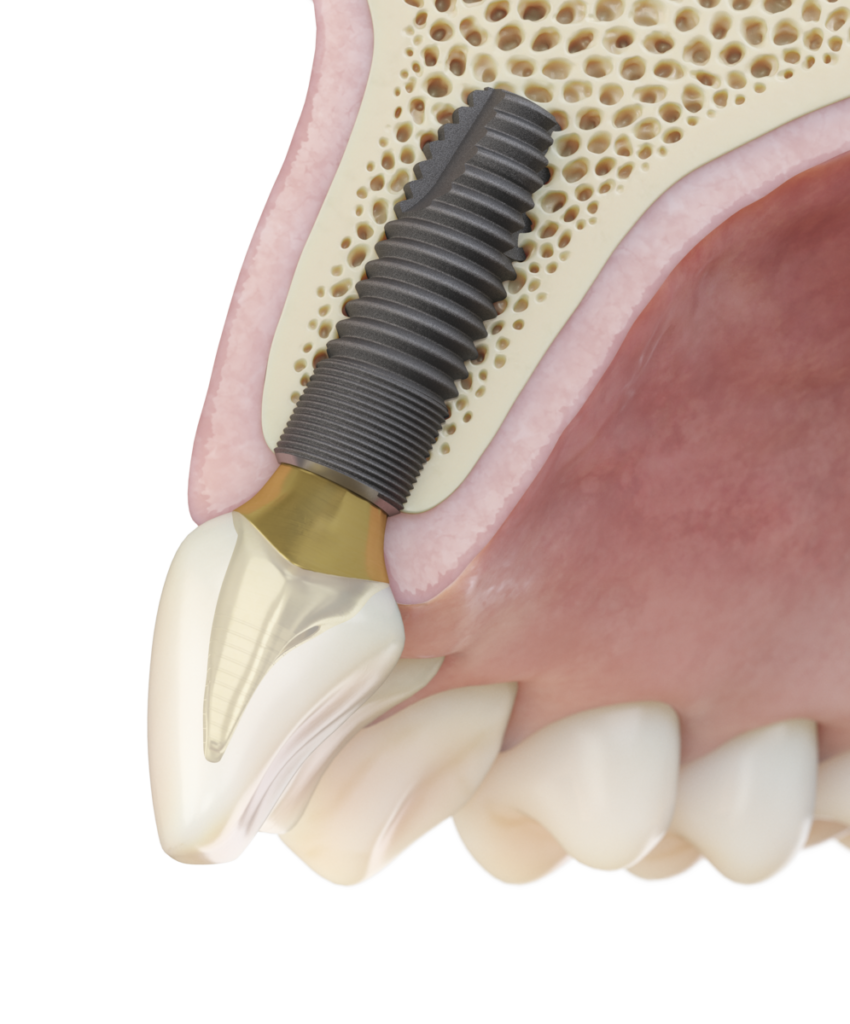 Havainnekuva hammasimplantista ruuvattuna hammasluun sisään.